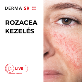 Derma SR Rozacea Kezelés ONLINE